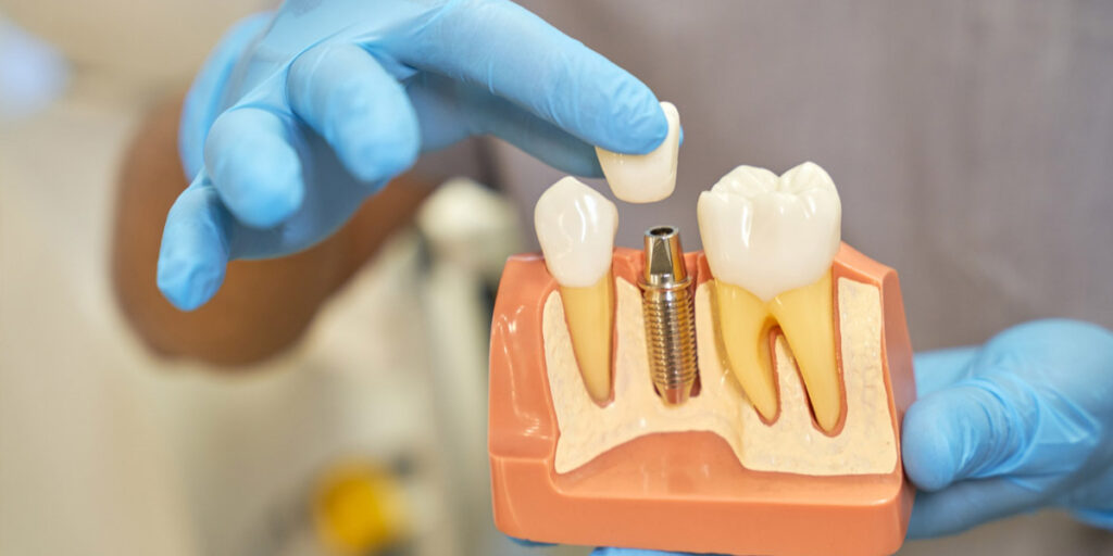 Implants Le Mans, Implants 72 : les implants, qu’est-ce que c’est ?