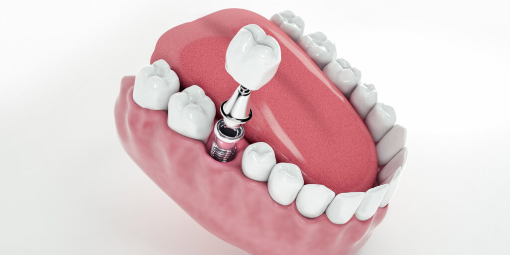 Pourquoi opter pour un implant dentaire ?