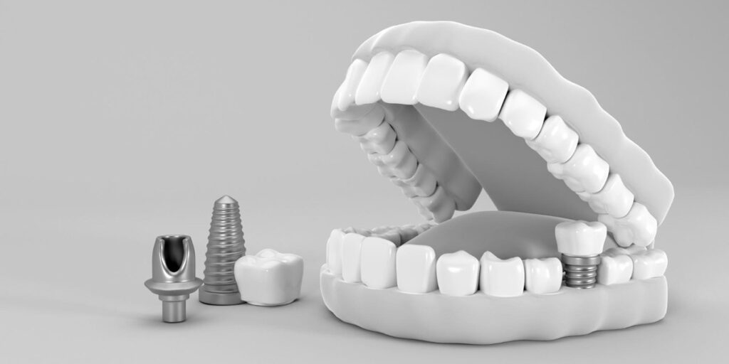 Tarifs et prise en charge des implants dentaires