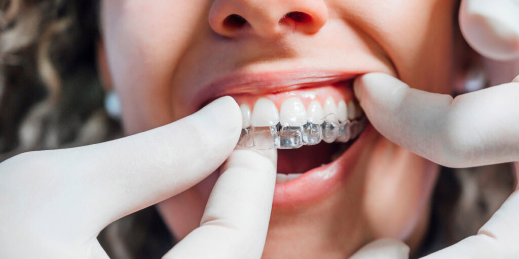 traitements orthodontiques au mans
